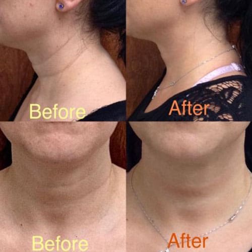 A woman 's neck before and after surgery.