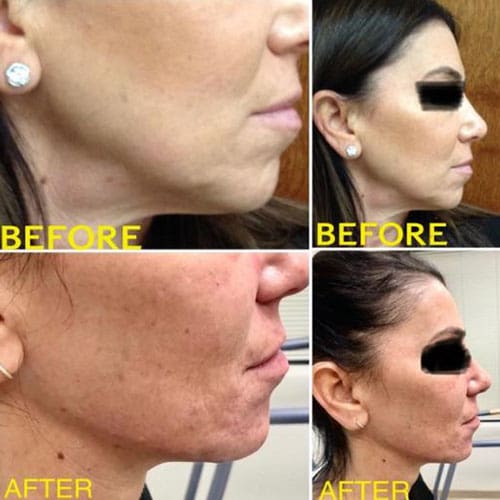 A woman with black eye makeup before and after surgery.