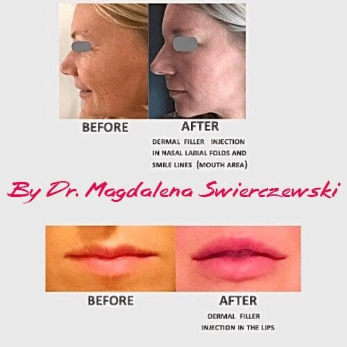 A before and after picture of the lips of an older woman.